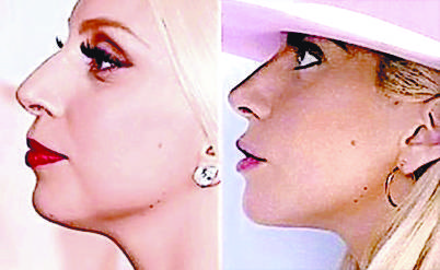 Critícan a Lady Gaga por cirugía