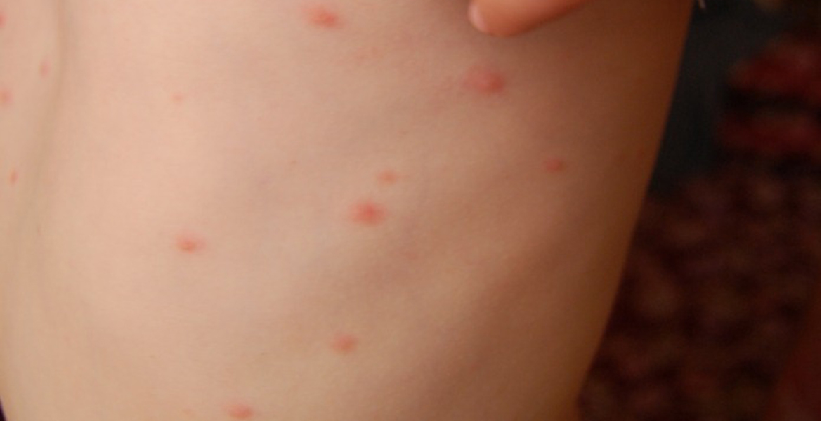 Encienden “alerta” en Yucatán por varicela