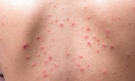 ¿Influenza? Hay 14 casos diarios de varicela en Yucatán, y si se combinan…