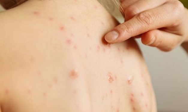 ‘Vigilan’ a 369 personas por caso de sarampión en Playa del Carmen