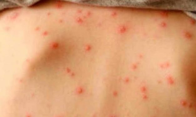 Contagiada de sarampión mujer residente en Playa del Carmen