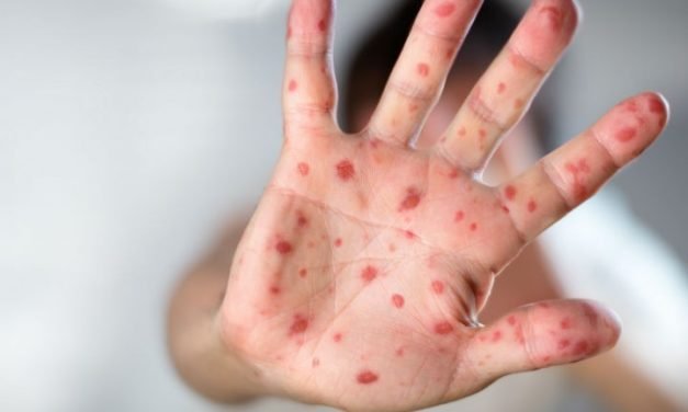 Confirman otro caso de sarampión importado en Quintana Roo