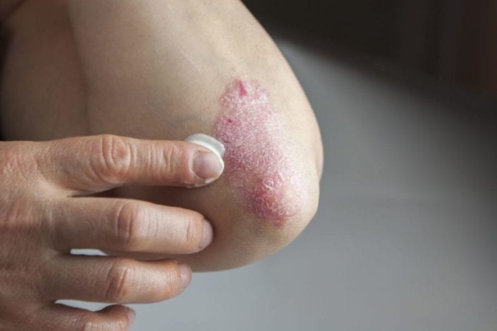 Qué es la psoriasis y por qué puede causar problemas en el corazón