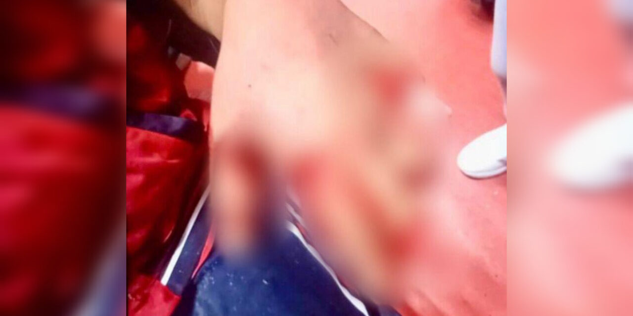 En Pachuca: Le explota pirotecnia entre manos y pierde varios dedos