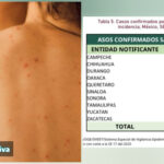 Reaparece sarampión en Yucatán; contagio confirmado en Valladolid