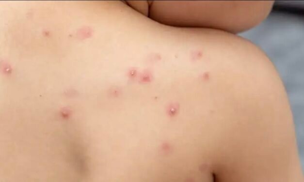 Tercera semana con positivo de Mpox en Yucatán