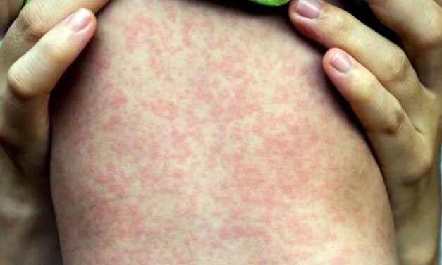 Niño de Izamal contagiado con sarampión