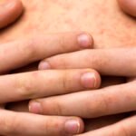 Personas sin vacunación, las más afectadas por sarampión