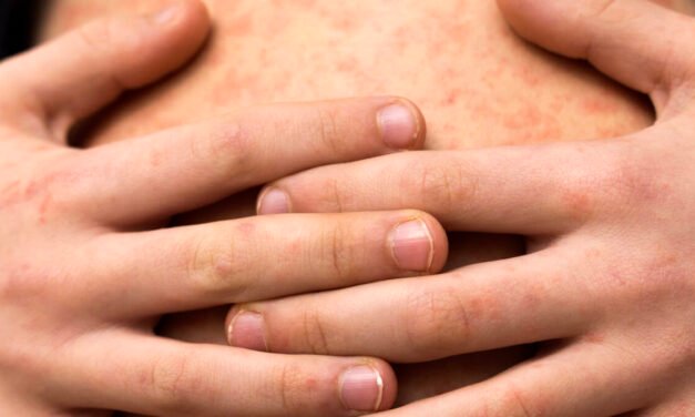 Personas sin vacunación, las más afectadas por sarampión