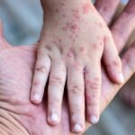 Península de Yucatán, zona de alto riesgo para sarampión