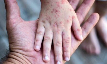 Península de Yucatán, zona de alto riesgo para sarampión