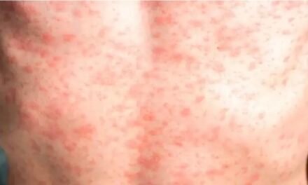 Familia completa estaría contagiada de sarampión en Mérida