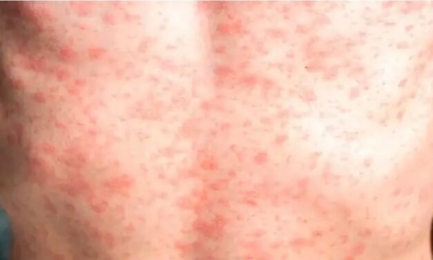 Familia completa estaría contagiada de sarampión en Mérida