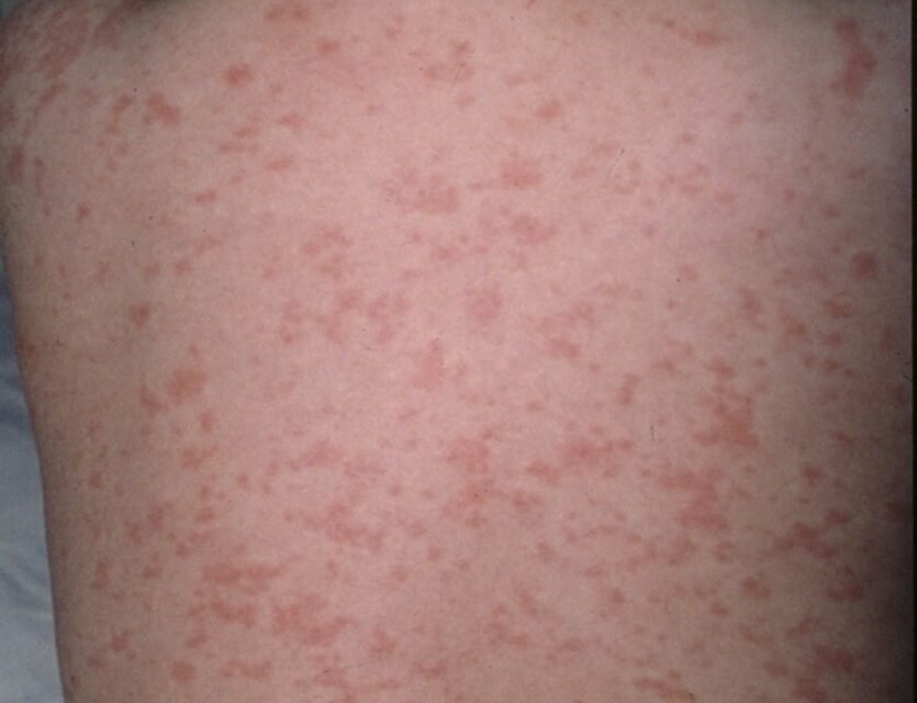 Dan de alta a primer contagiado de sarampión en Mérida