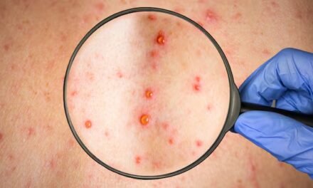 Suma Yucatán tres contagiados de sarampión