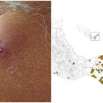 Acumula Yucatán nuevos casos de gusano barrenador en humanos