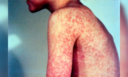 Propagación en ascenso del sarampión