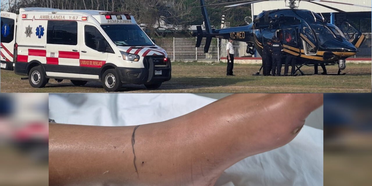 Niña atacada por cascabel en Tizimín lucha por sobrevivir