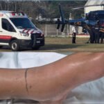 Niña atacada por cascabel en Tizimín lucha por sobrevivir