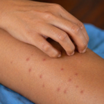 Sarampión sigue con aumento sostenido en Yucatán