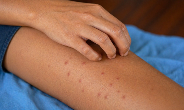 Sarampión sigue con aumento sostenido en Yucatán