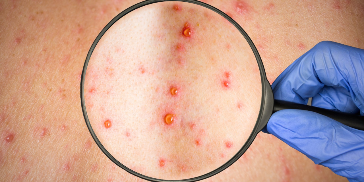 Acelera sarampión en abril, a un año de su reaparición