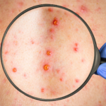 Acelera sarampión en abril, a un año de su reaparición