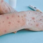 Repunte de Mpox enciende luces preventivas