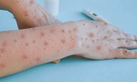 Repunte de Mpox enciende luces preventivas