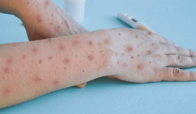 Repunte de Mpox enciende luces preventivas