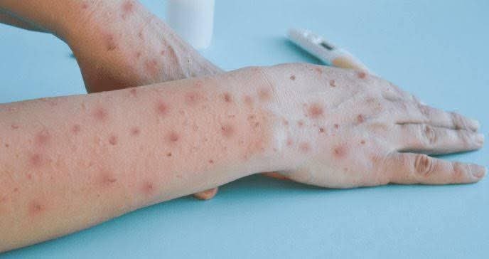 Repunte de Mpox enciende luces preventivas